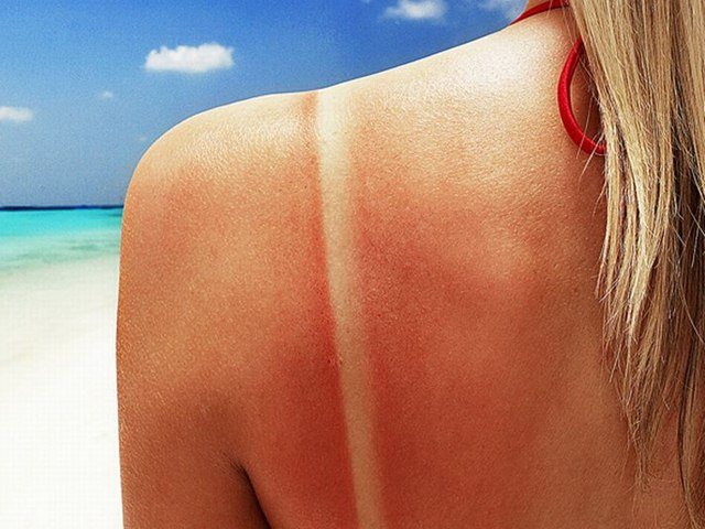 Ways to Soothe Sunburned Skin
