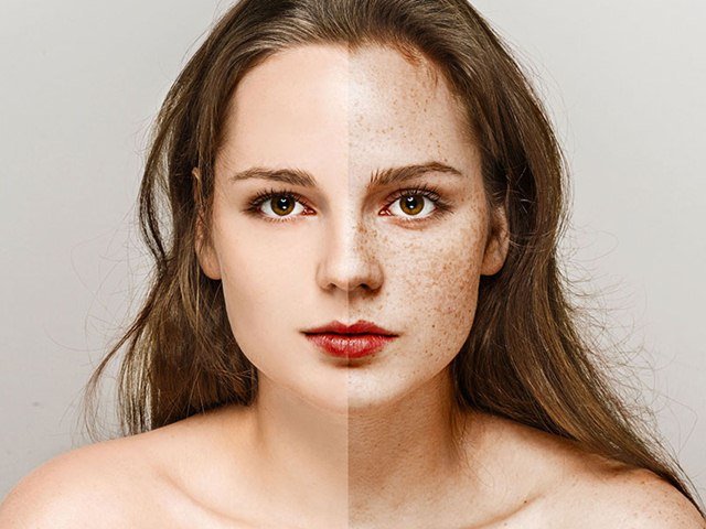 Home Remedies to Remove Freckles, natural treatments for freckles, how to treat freckles at home
