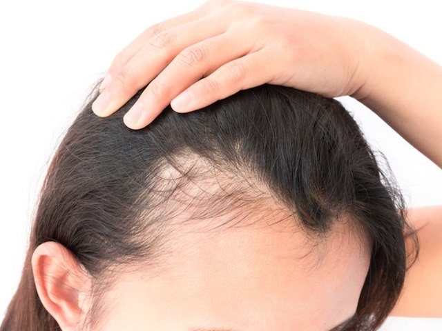 6 Most Effective Home Remedies to Treat Baldness